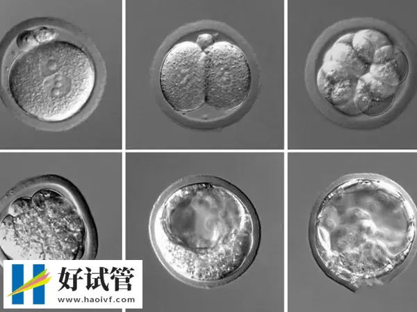 黔东南试管婴儿的胚胎等级如何划分(图1) 胚胎等级代表着胚胎的质量