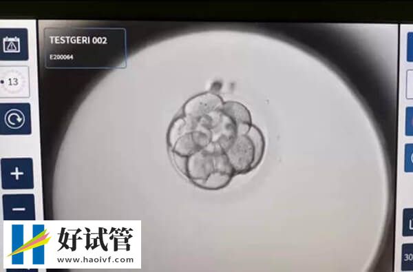 巴中试管婴儿能不能经阴超下进行胚胎移植(图1) 阴超下进行胚胎移植能找准位置