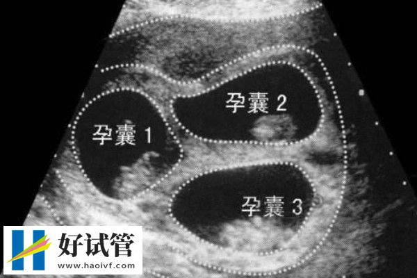 做试管婴儿攒胚胎和养囊胚胎区别是什么(图2) 胚胎移植是将胚胎放在宫腔中
