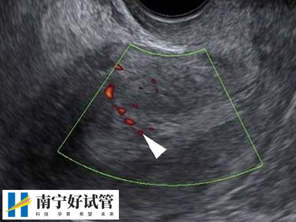 试管取完卵什么时候复查(图2)