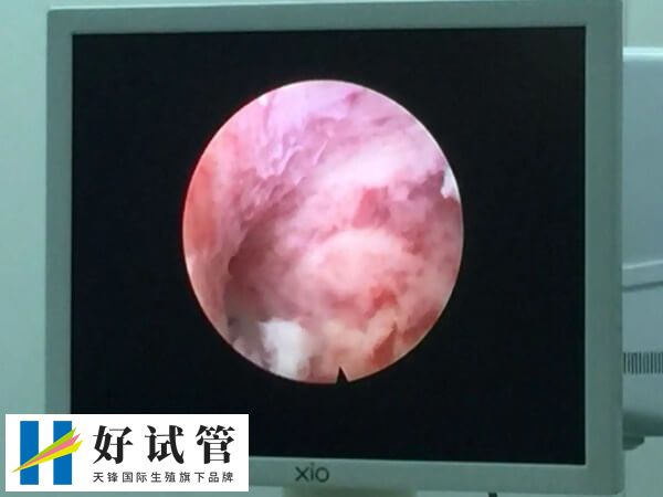 宫腔镜能够排查子宫问题